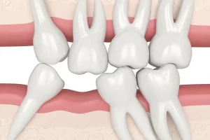 Movement Of Teeth