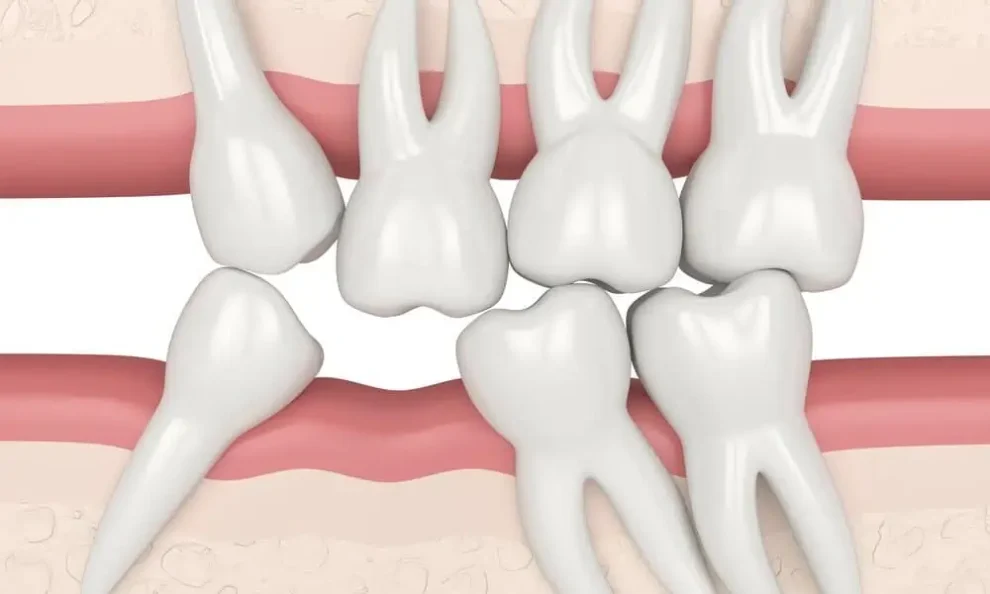 Movement Of Teeth