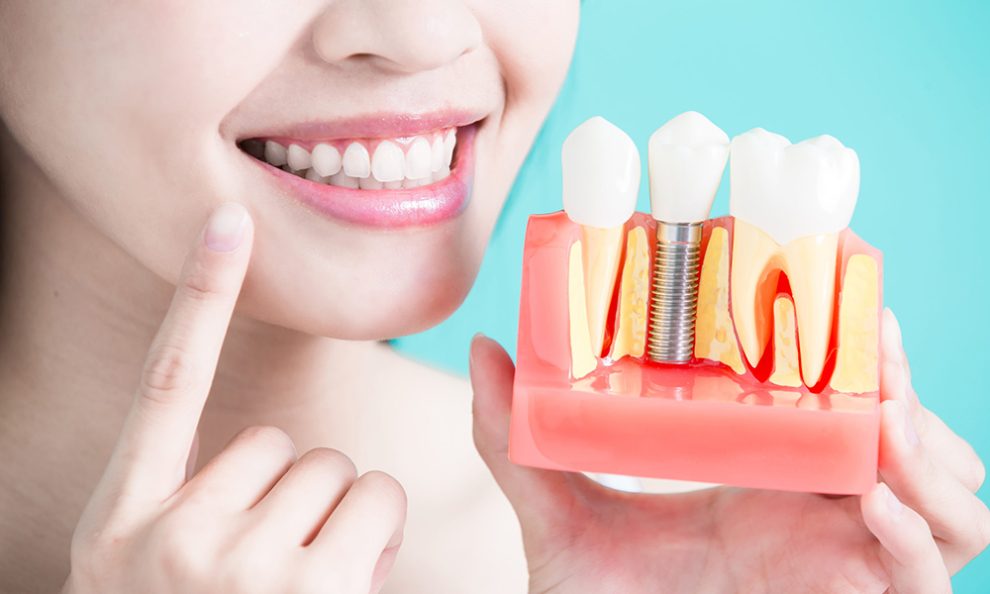 Dental Implant