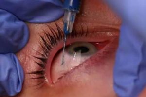 LASIK Eye Surgery