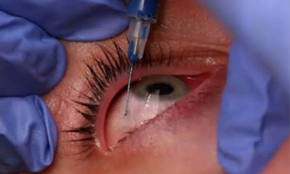 LASIK Eye Surgery