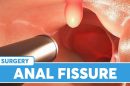 Anal Fissure