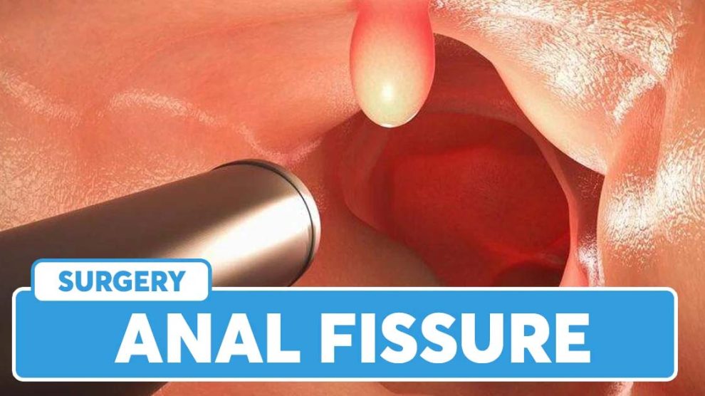 Anal Fissure