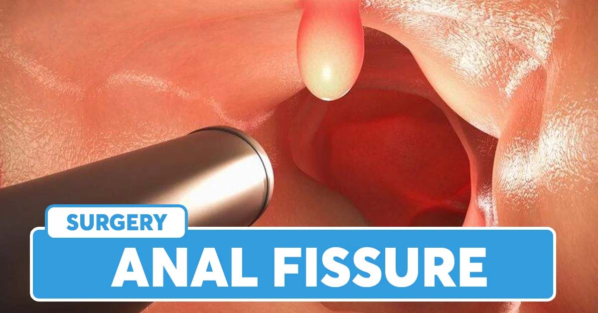 Anal Fissure